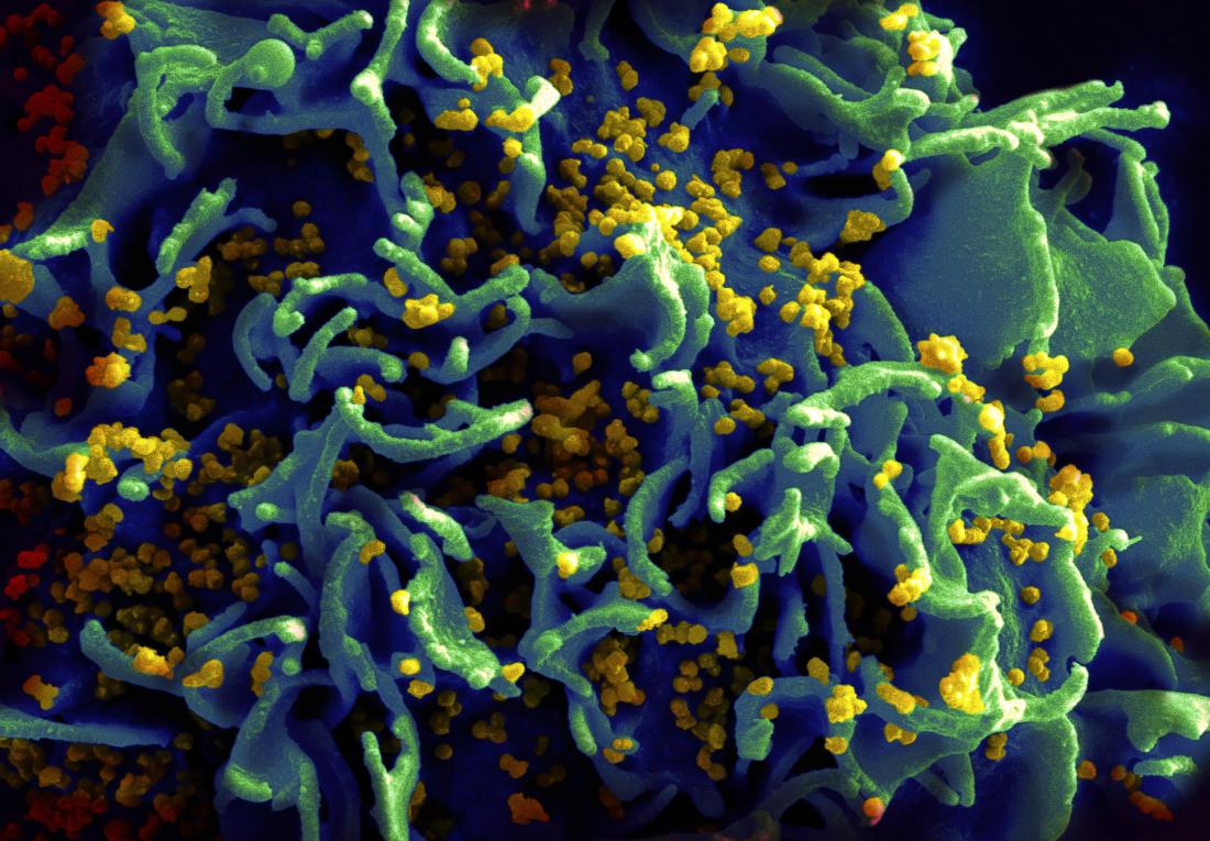 HIV infecting T-cell - Getty images.jpg